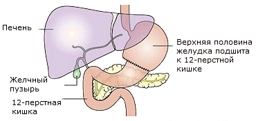 Половина желудка. Люди после удаления желудка. Убрать половину желудка. Удаление половины желудка. Спайка кишечника с желчным пузырем.