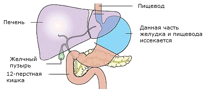 Удаление желудка